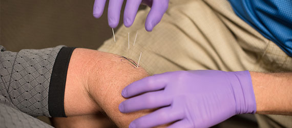 Dry Needling Therapy